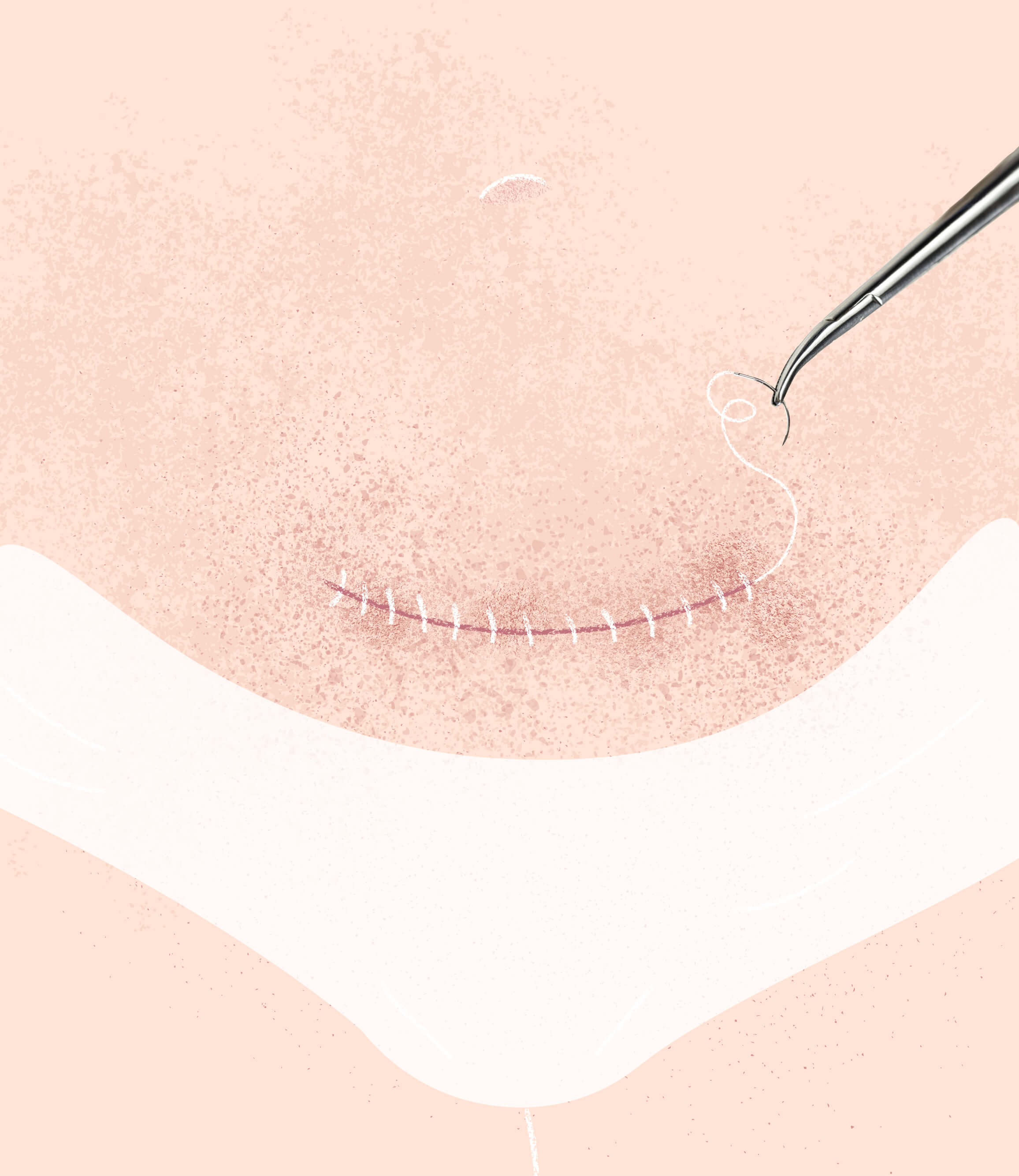 Kaiserschnitt – Klarheit für deine Geburtsvorbereitung